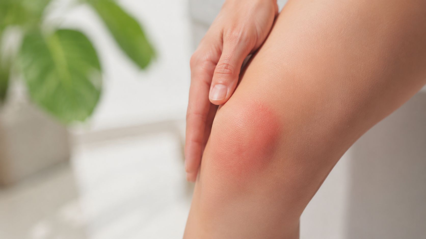Et nærbillede af et knæ med rødme og inflammation, der viser symptomer på en mulig knæskade eller ledbetændelse.